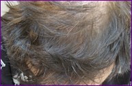 After 2nd hair restoration